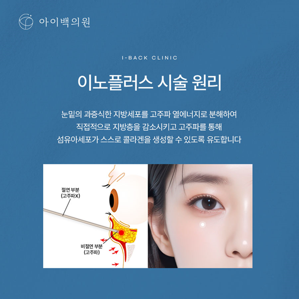 강남역 아이백의원 눈밑지방재배치,절개 없이 눈밑을 개선하는 방법