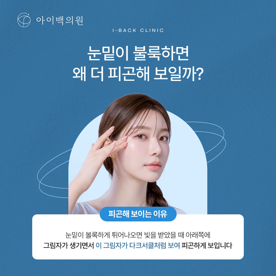강남역 아이백의원 눈밑지방재배치,절개 없이 눈밑을 개선하는 방법