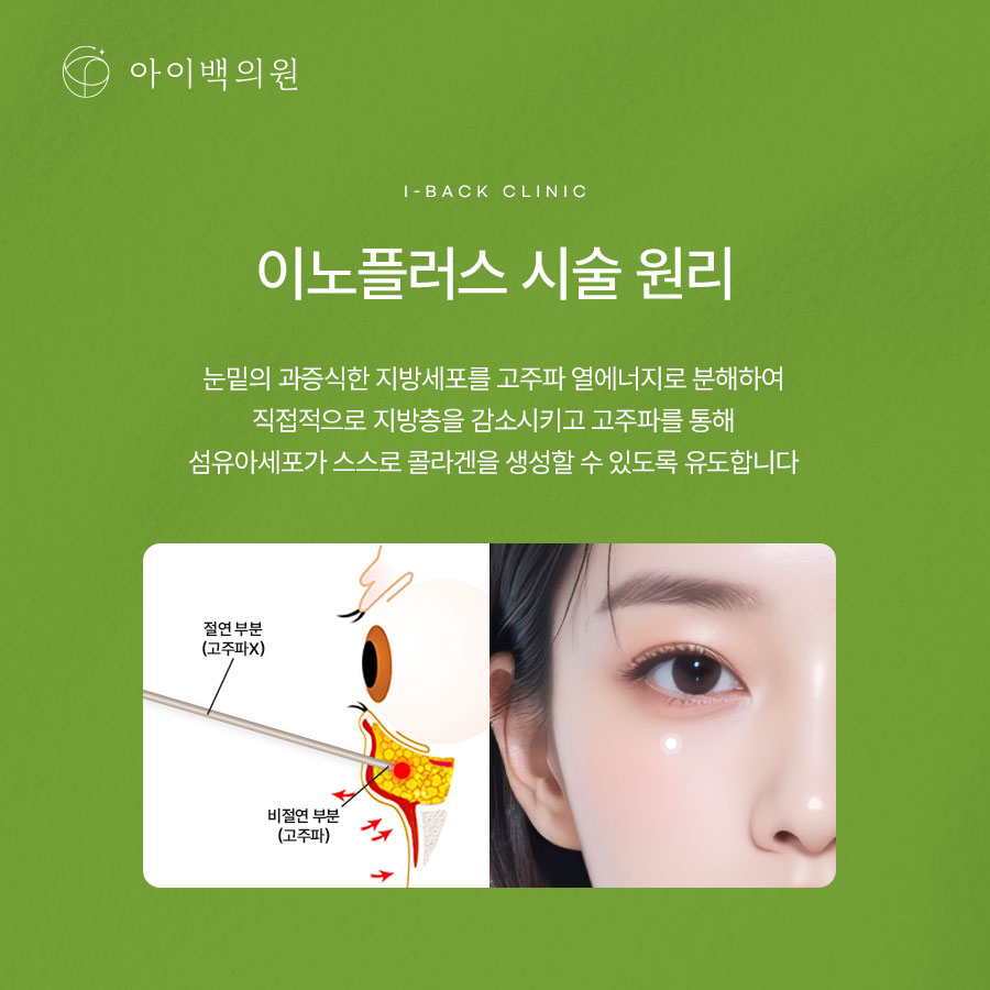 역삼동 아이백의원 눈밑지방재배치,눈 밑이 불룩해 보인다면 원인부터 확인해 보세요