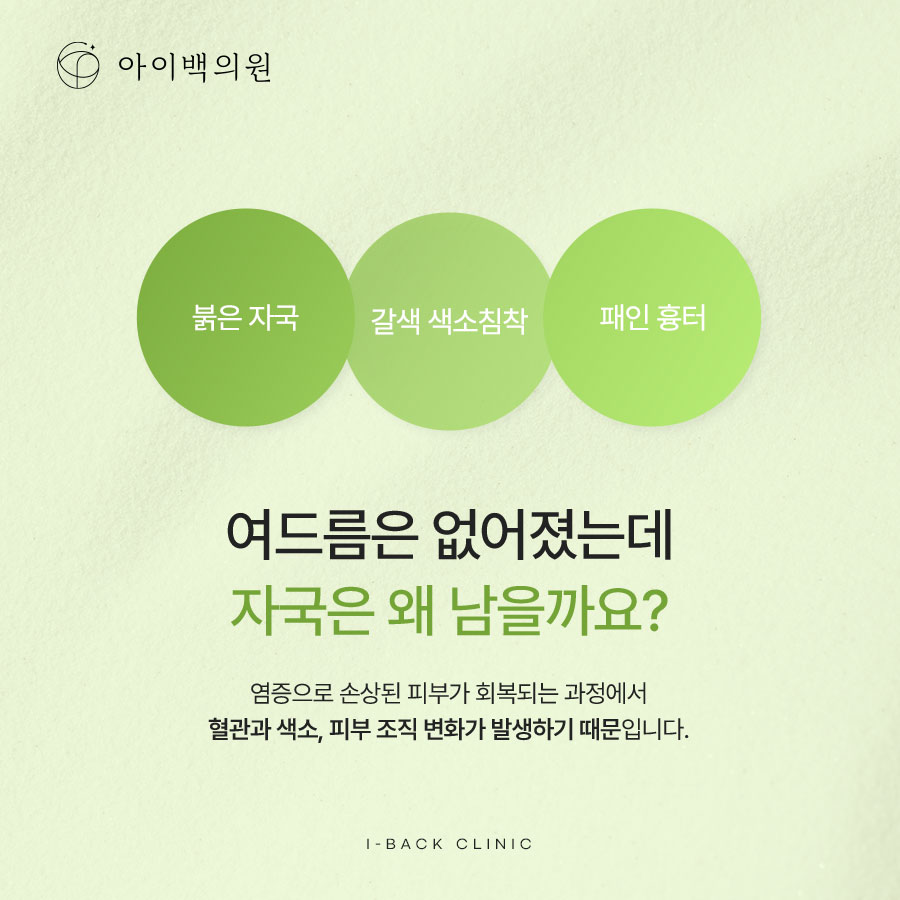 강남 아이백의원 여드름색소침착,시간이 지나도 옅어지지 않는다면?