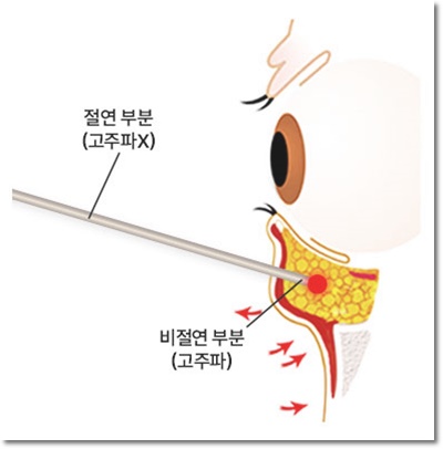 완전 비절개 눈밑지방재배치, 왜 경험이 중요할까요 - [아이백의원]