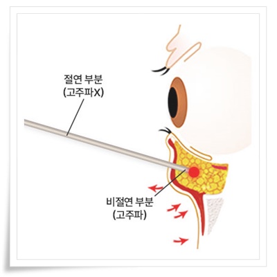 역삼동 눈밑지 잘하는곳? 아이백의원 비절개 눈밑지방재배치!