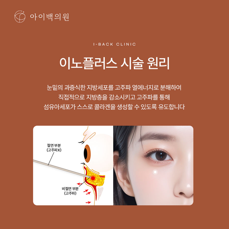 강남 비절개 눈밑지방재배치,의료진의 숙련도가 중요한 이유?