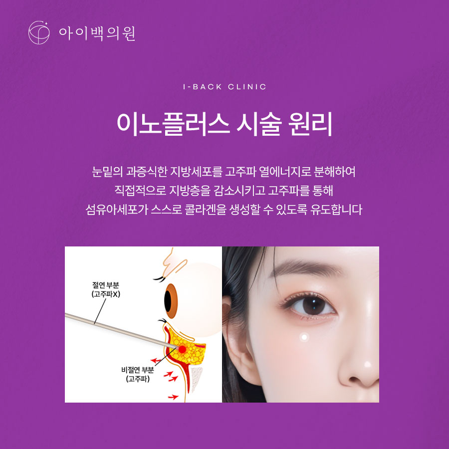 신논현 아이백의원 눈밑지방재배치,돌출되고 처지는 눈밑 변화가 시작됐다면