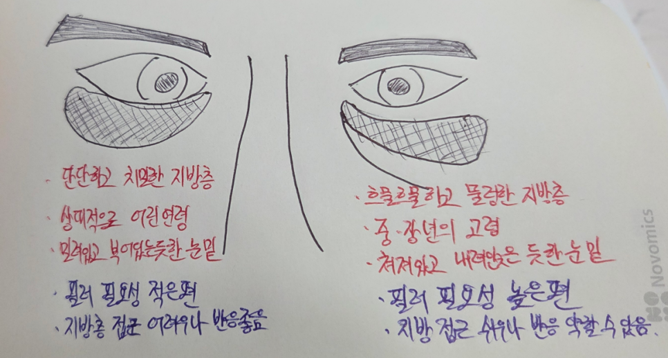 [아이백의원] 눈 밑 지방의 유형과 그에 따른 접근의 차이