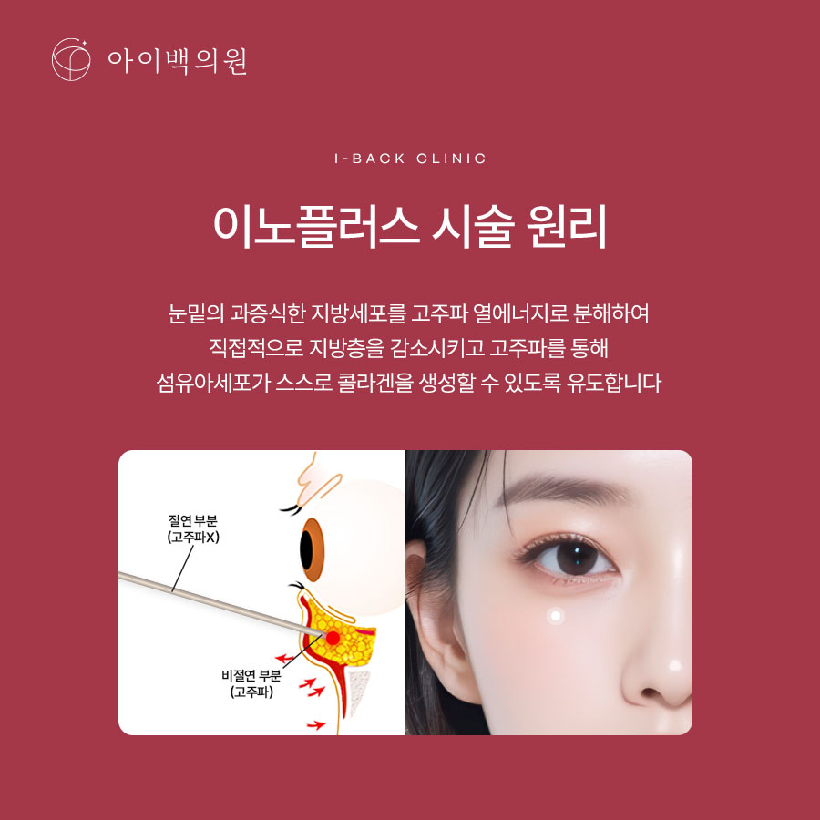 레이저 눈밑지방제거, 맞는 표현일까요? 이노플러스의 정확한 원리와 특징